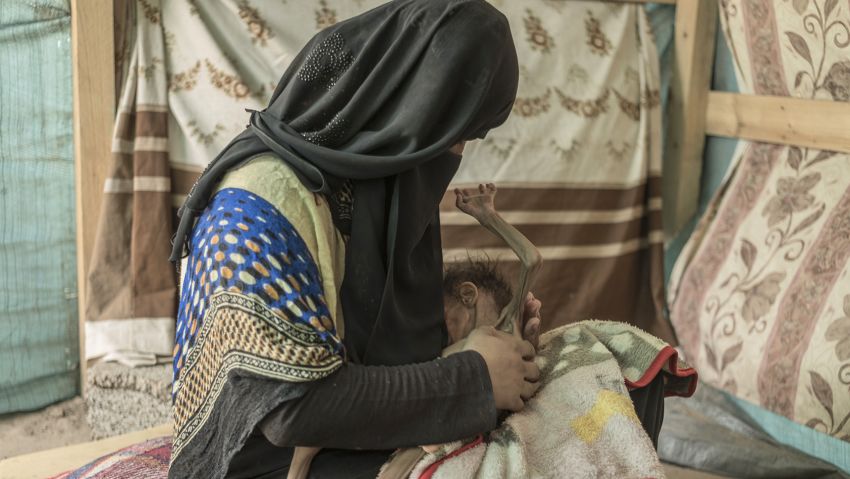 Mariam holds here malnourished 9-year-old daughter, Mailiki, at Camp al Mahu near Lahj in Yemen.