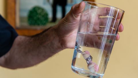 David Tuller's removable partial denture. Despite regular checkups, he developed advanced periodontitis.