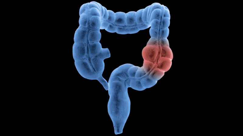 Colorectal Cancer Rise in Adults Under 55, Reported