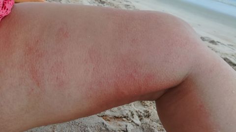 A red rash resulting from a jellyfish sting on Kronk's leg