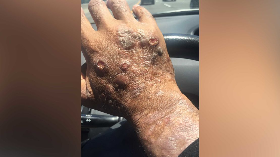 Johnson had lesions on most of his body, a doctor said.