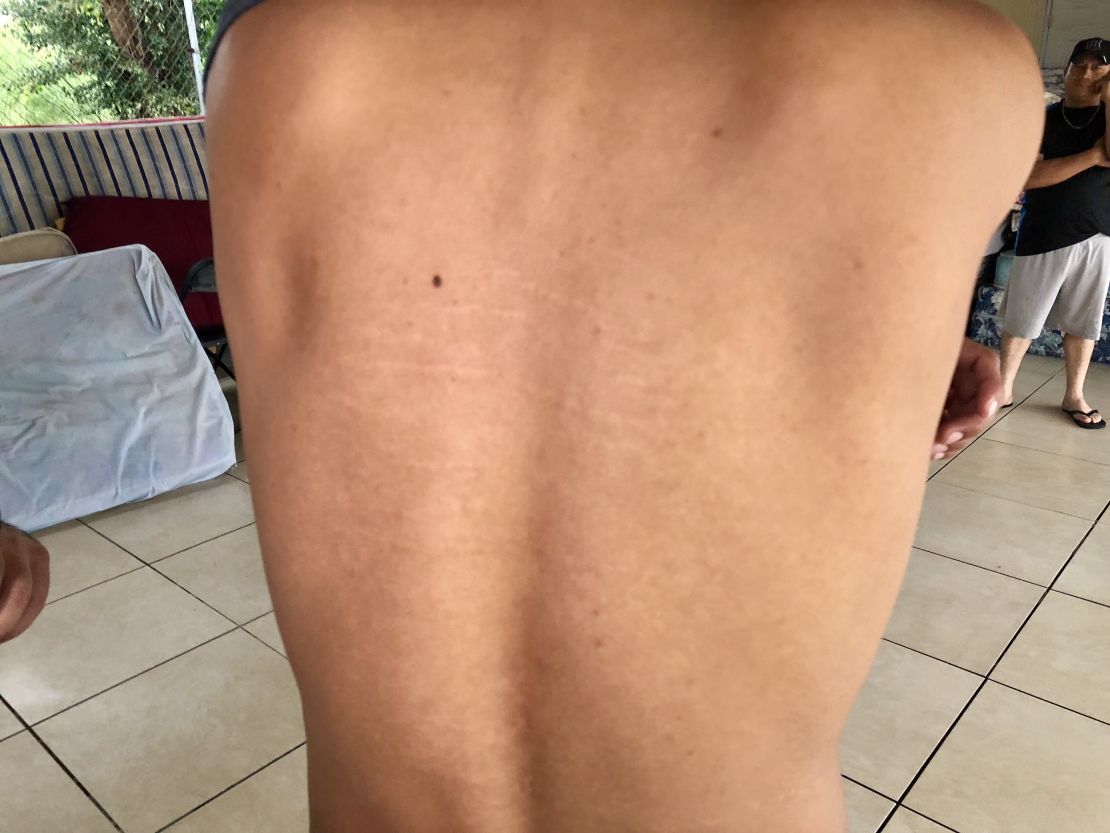 Christian Ortiz, a migrant from Honduras, shows scars he said are from lashings by gang members. 