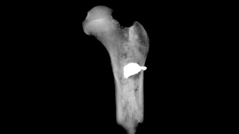 X-ray shows the position of the embedded bullet in the right femur of a soldier.