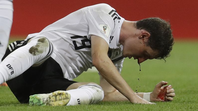 Blood drips from the face of Germany's Sebastian Rudy during the soccer match between Germany and Sweden on Saturday, June 23.
