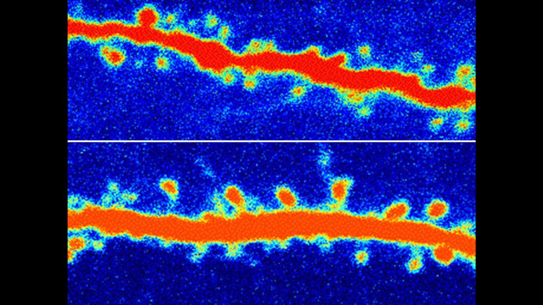 A rat neuron before, top, and after ketamine treatment. The increased number of orange nodes are restored connections in the rat's brain.