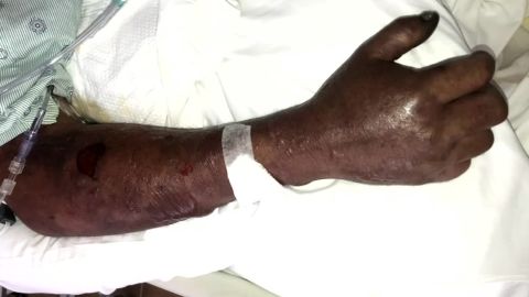 The infection spread to Perez's limbs. His daughter said the "choice is life or limbs."