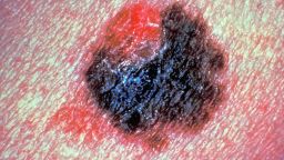 390487 07: (FILE PHOTO) Detail of a person with a malignant melanoma, which is a malignant skin tumor that involves the skin cells that produce pigment. (Photo by American Cancer Society/Getty Images)