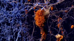 Brain nerve cells affected by alzheimers, computer illustration.