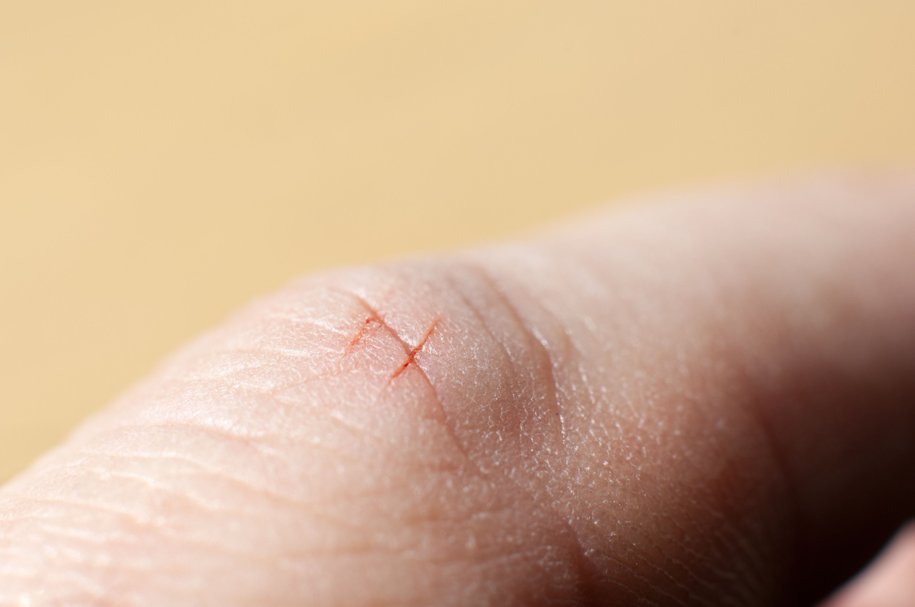 Why a tiny paper cut can cause such agony