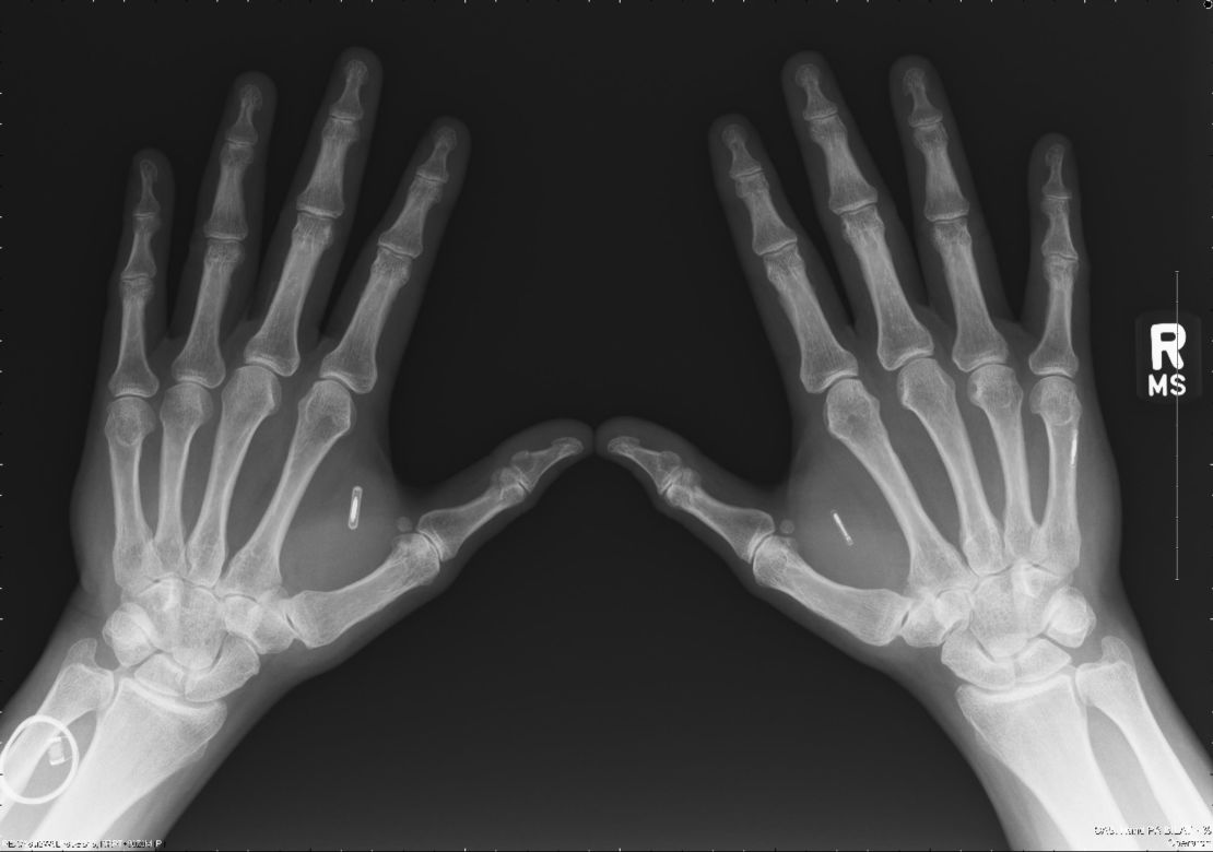 An x-ray of Amal Graafstra's hands reveal his implants. One of them helps him unlock doors without keys.