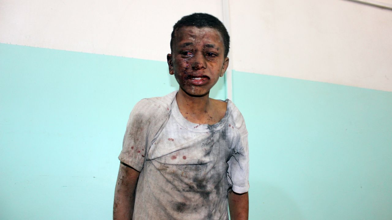 A Yemeni child injured in Thursday's airstrike on a schoolbus.
