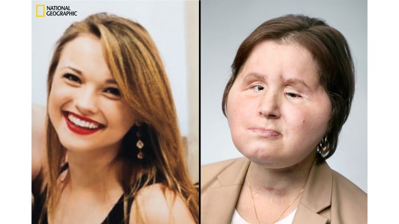 Katie Stubblefield Face transplant gives suicide survivor a second chance pic pic