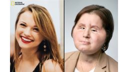 Katie's face in 2013, before her suicide attempt (on left). Katie after her face transplant procedure, which took place last year (on right). She is now in recovery.