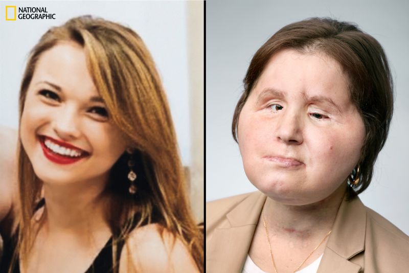 Katie Stubblefield Face transplant gives suicide survivor a second chance photo