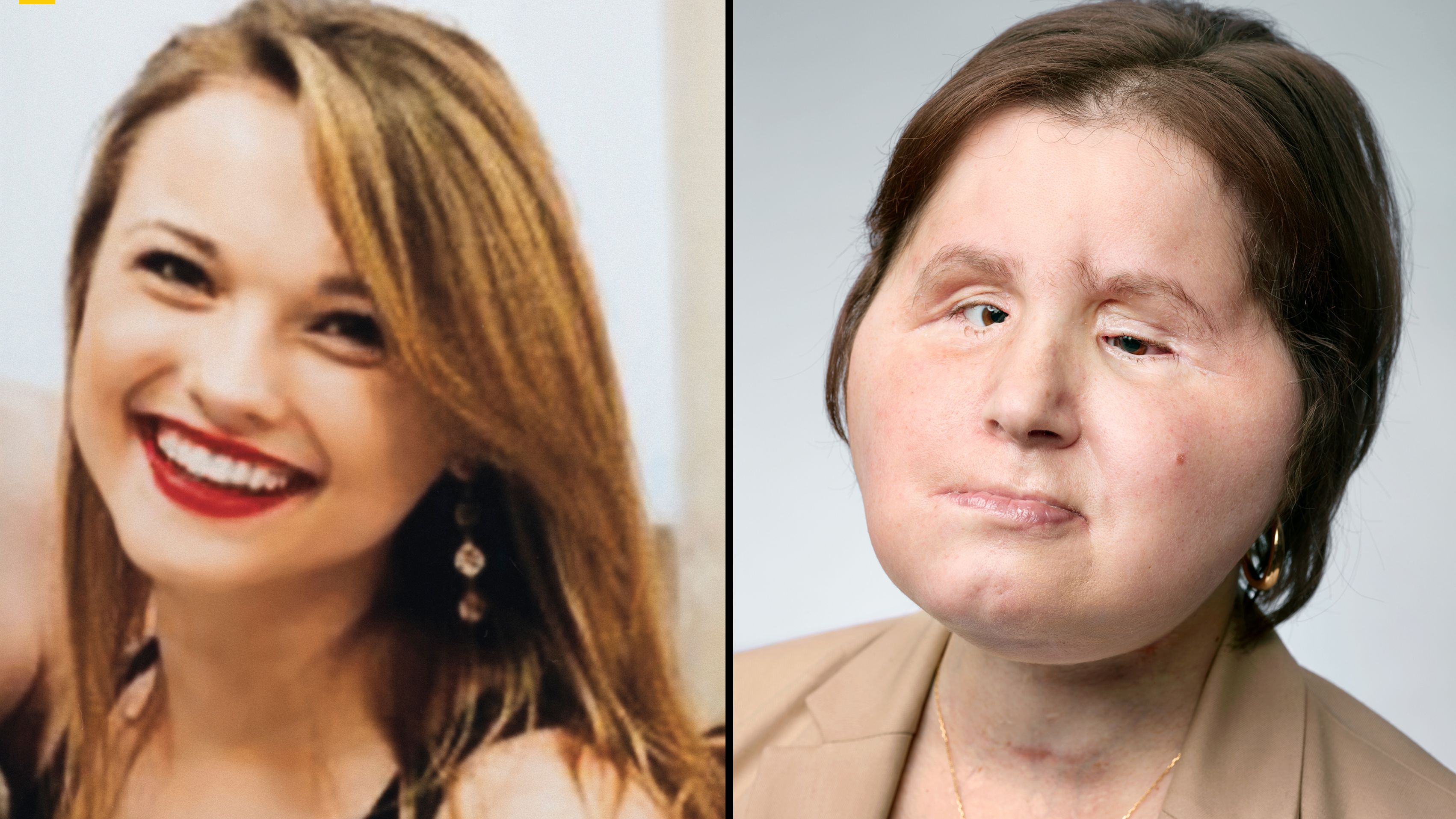 Katie Stubblefield: Face transplant gives suicide survivor a 'second  chance' | CNN