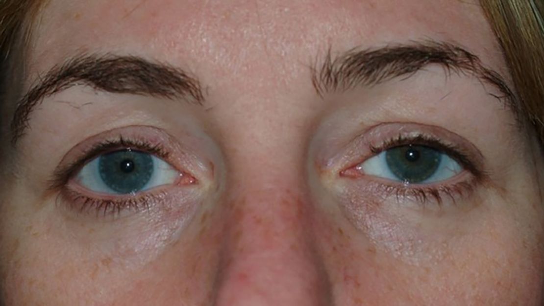 Slight swelling and a bit of a droop can be seen in the woman's left eye.