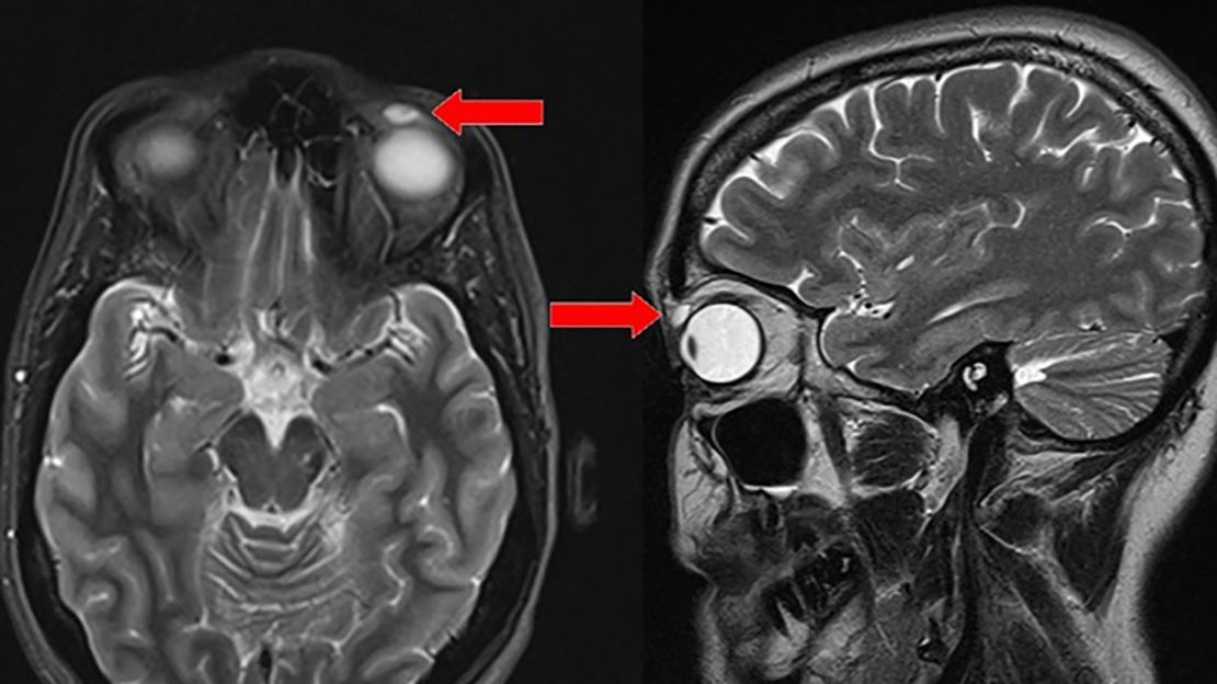 The encapsulated contact can be seen on an MRI.