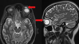 T2-weighted MRI of the head: transverse and sagittal views. Red arrow: high-intensity signal nodular lesion in the left upper eyelid. 