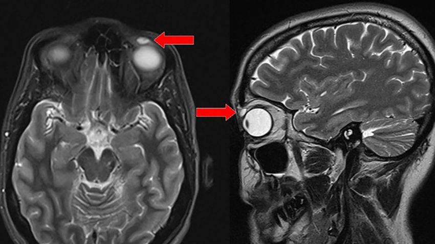 T2-weighted MRI of the head: transverse and sagittal views. Red arrow: high-intensity signal nodular lesion in the left upper eyelid.