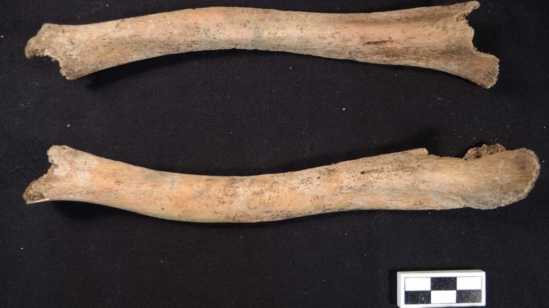 The leg bones of a 7-year-old, recovered from an ancient Roman cemetery, show bending and deformities associated with rickets.