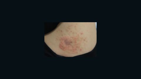 An example of contact dermatitis