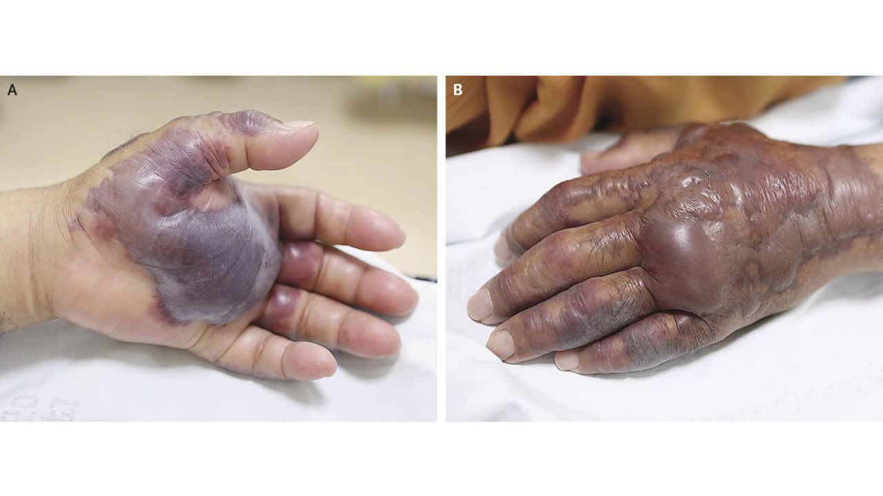 The man's hand and arm were swollen by the time he reached the ER.