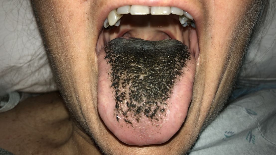 A woman developed "black hairy tongue" after taking an antibiotic for a wound infection. This image appears in her case report.