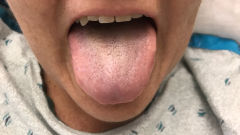 About a month later, the patient's tongue was no longer of the black hairy variety.