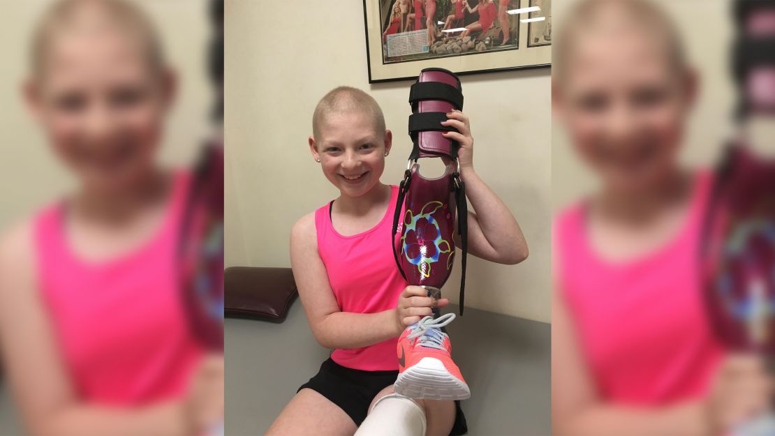 Delaney Unger shows off her prosthetic "knankle."