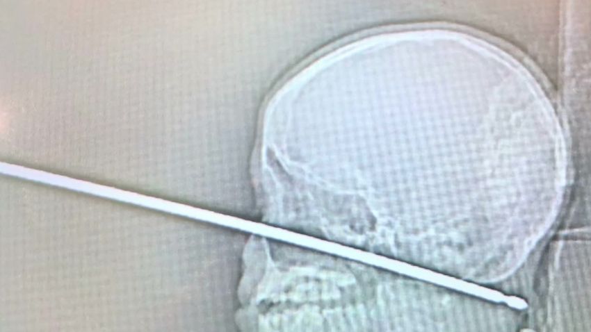 boy survives falling on meat skewer 1