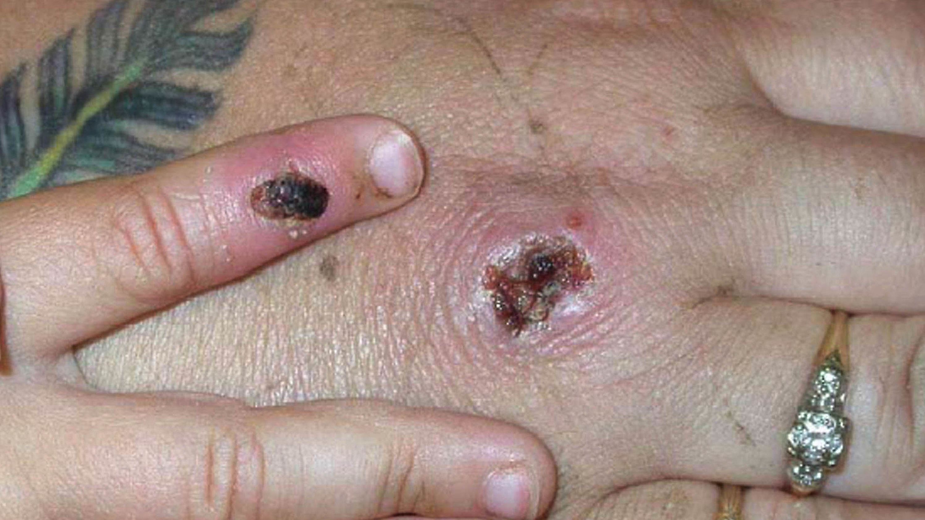 monkeypox symtpoms FILE