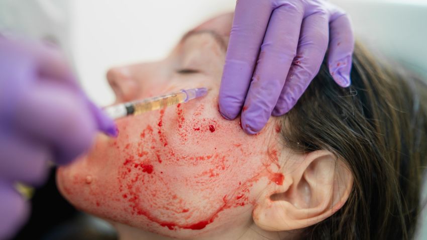 Close-up photo of doctor applying blood plasma during PRP vampire facelift.