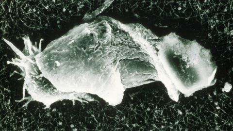 The infection is caused by the microorganism Acanthamoeba.