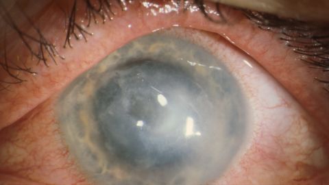 Some patients with Acanthamoeba keratitis require cornea transplants.