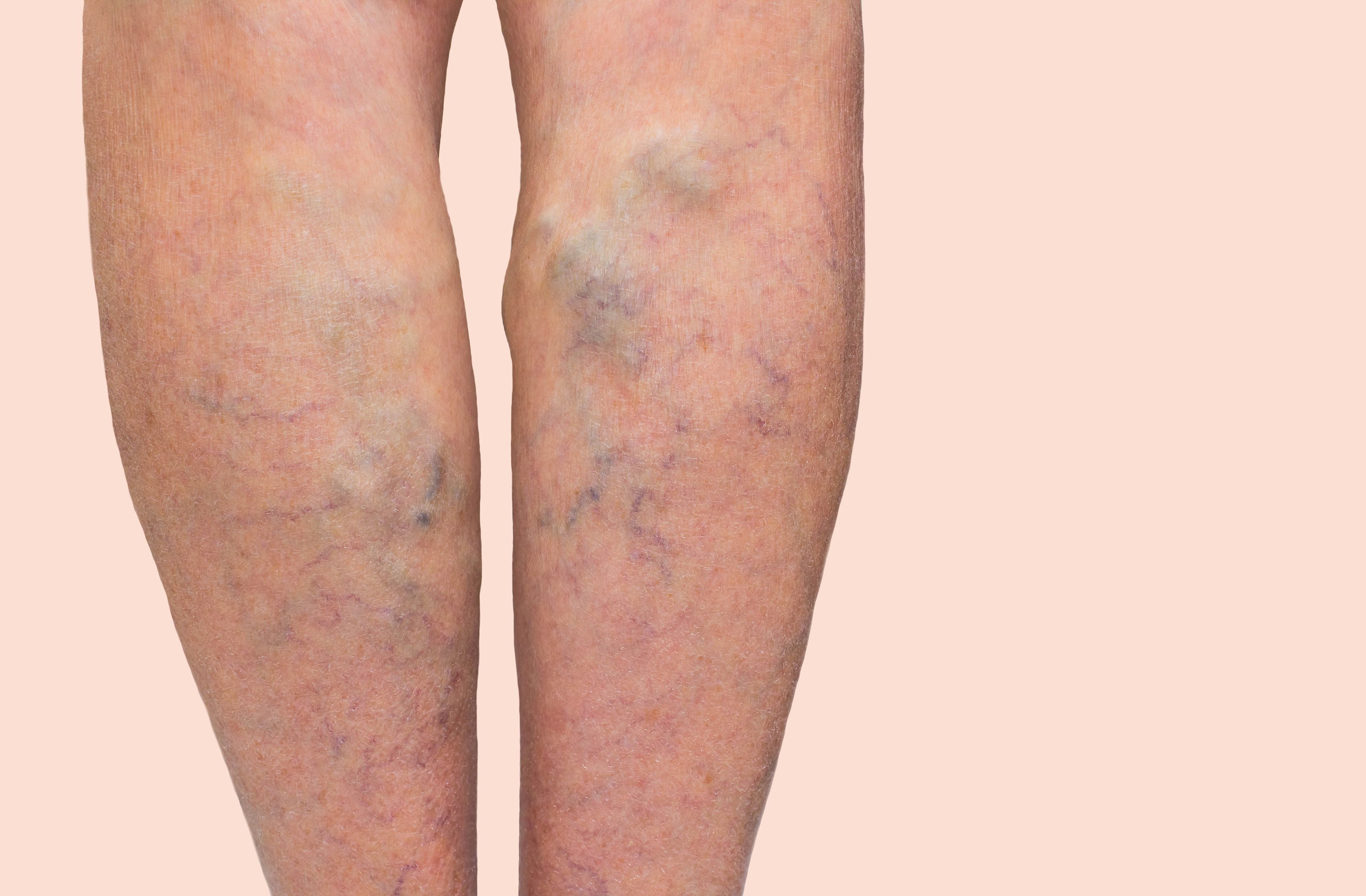 Why Are Women More Susceptible to Varicose Veins?