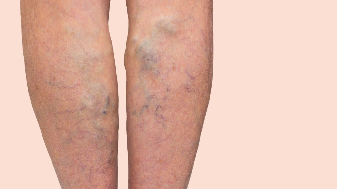 Varicose veins in a woman's legs.