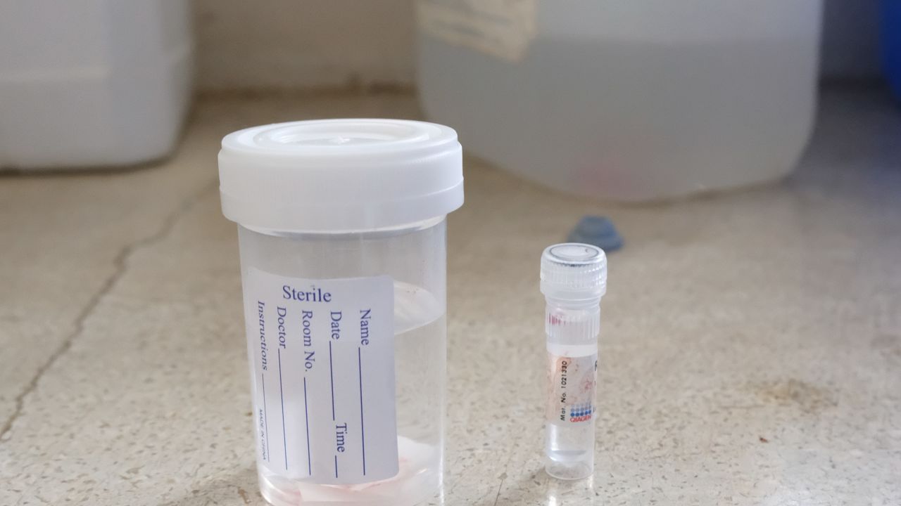 Oesophageal tumour samples taken at Moi Teaching and Referral Hospital, in Eldoret, Kenya.