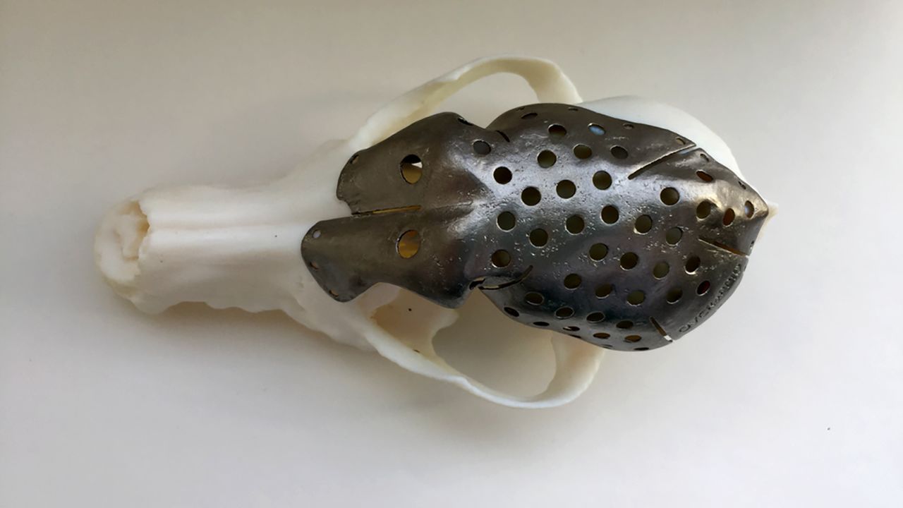 Doctors custom made a skull implant with 3D printing.