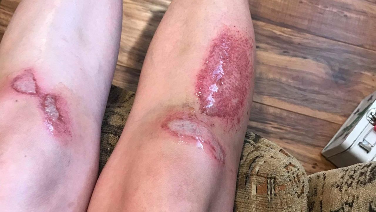Daniela Rivera, a 25-year-old living in L.A., said she wasn't able to work for more than a week after her scooter accident.