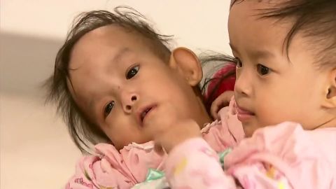 Bhutanese twins Dawa and Nima are joined at the abdomen and have grown up facing each other, unable to move freely. 