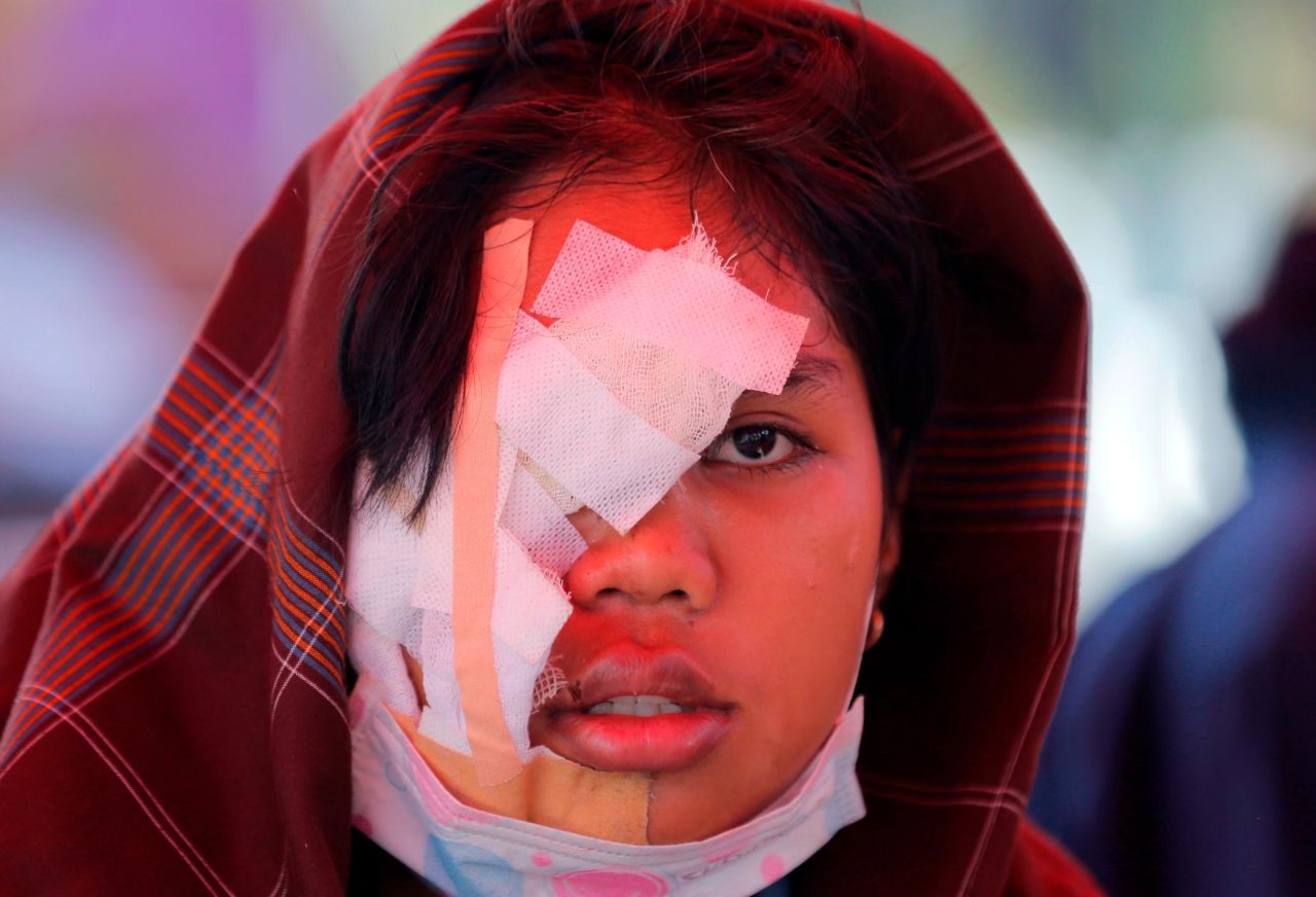 A victim's face is bandaged at a makeshift hospital in Palu on October 3.