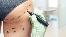 plastic surgeon marking womans body for surgery; Shutterstock ID 604596626; Project Name: -