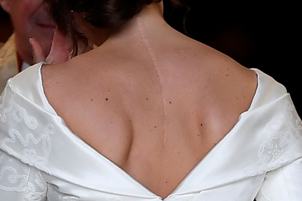 Princess Eugenie's low back dress revealed scars from a childhood operation. A conscious statement by the royal.