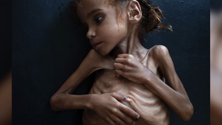 #NEWS: Girl in iconic NYT image depicting Yemen famine dies ~ Yemen Health Ministry
Amal Hussein, a 7-year-old girl whose iconic image was captured by the New York Times has died, the Yemeni Health Ministry has confirmed. The stark photo of her emaciated body is one of the searing images of the Yemen's civil war. A week after the image was published, and amid the international furor over the brutal killing of Saudi journalist Jamal Khashoggi in Saudi Arabia's consulate in Istanbul, US Secretary of Defense Jim Mattis and Secretary of State Mike Pompeo called on the participants in Yemen's 3-year civil war to agree to a ceasefire "in the next 30 days".
~From journalist Hakim Almasmari in Sanaa. Opening line by CNN's Dan Wright in London.
~Background from excellent digital write by Kevin Liptak, Elise Labott, and Zachary Cohen