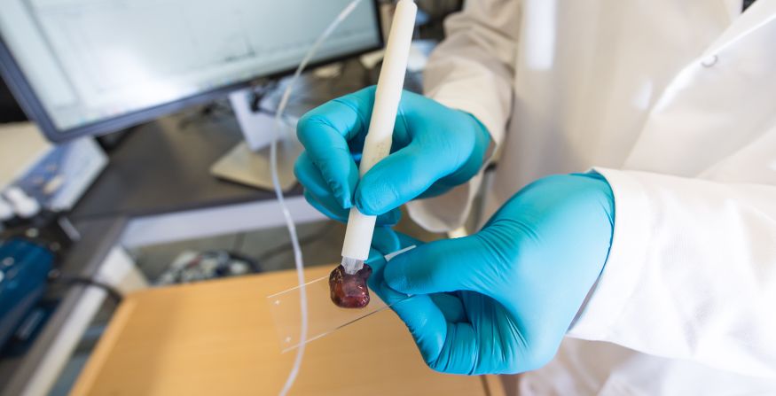 A team from the University of Texas at Austin developed a handheld device for high-speed cancer identification. Its makers claim the MasSpec Pen can detect cancerous tissue mid-surgery in 10 seconds, versus 30 minutes using a microscope. The pen, when touching suspect tissue, releases a droplet of water which takes up chemicals from inside human cells, which is sucked into the pen for analysis.