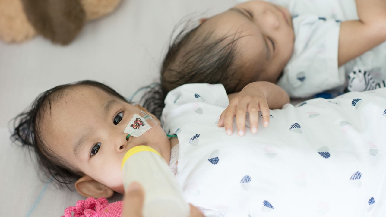 Lead pediatric surgeon Joe Crameri said the twins were getting back to normal life by eating again and starting to move around.