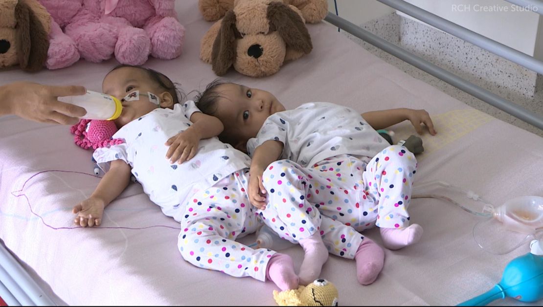 The 15-month-old twins flew nearly 6,000 mlies to Australia for the life-changing operation.