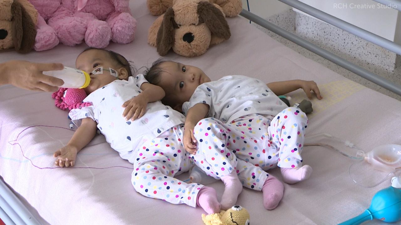 The 15-month-old twins flew nearly 6,000 mlies to Australia for the life-changing operation.