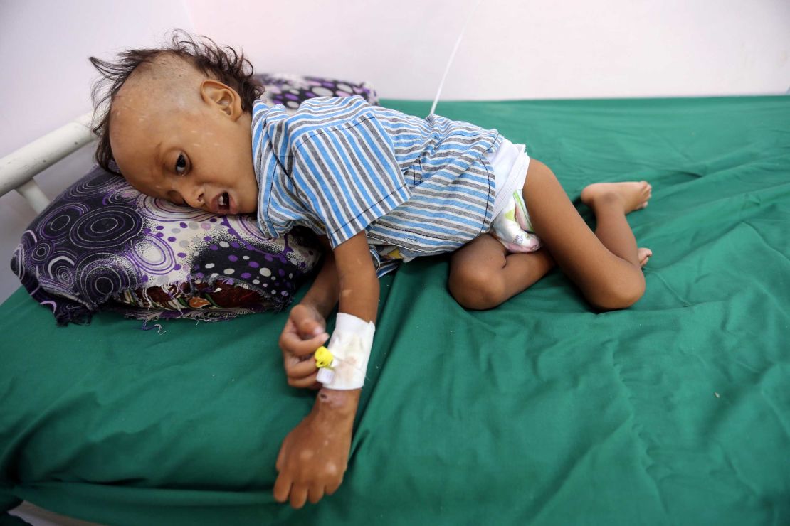 A 2-year-old boy lies on a bed at the al-Thawra hospital in Hodeidah where he receives treatment for malnutrition on November 17.