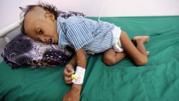 Jibril Mohammed Ali Al-Hakami, 2, lies on a bed at the al-Thawra hospital where he receives treatment for malnutrition in Hodeidah, Yemen November 17, 2018. Picture taken November 17, 2018. REUTERS/Abduljabbar Zeyad